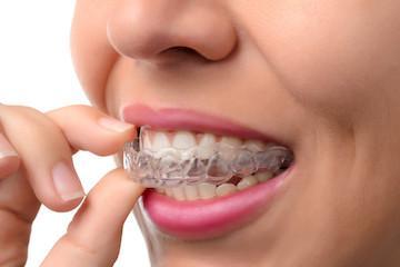 Invisalign in South Riding, VA | Pinebrook Dentistry Aligner
